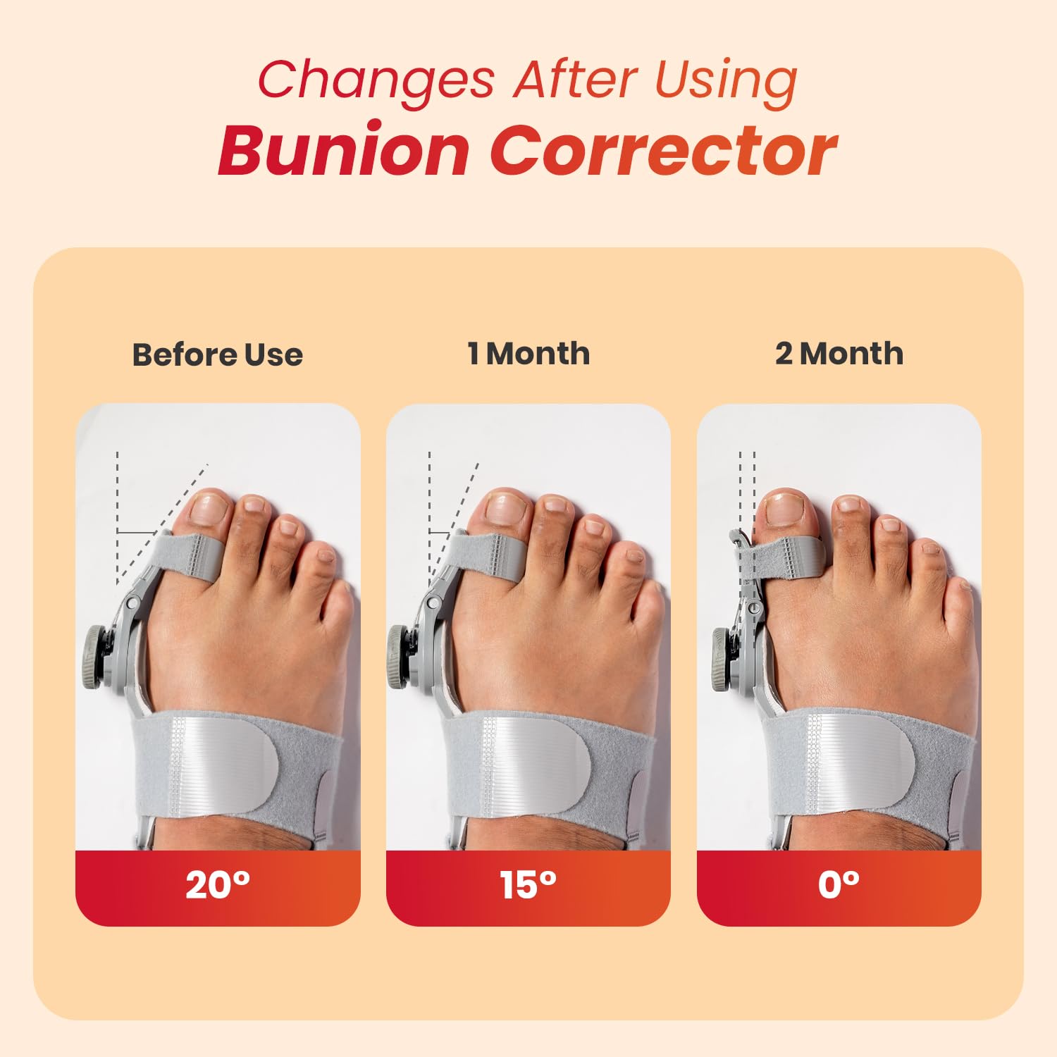 Bunion Splint